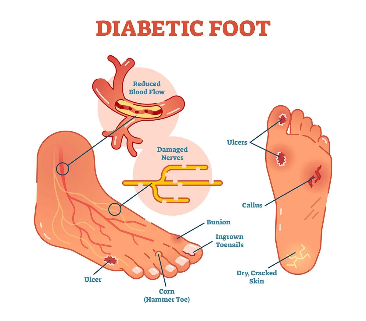 Early Stage Diabetic Foot Ulcer: Symptoms, Causes, and Care